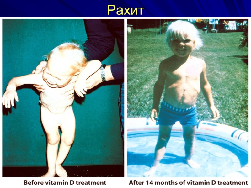 Рахит Рахит